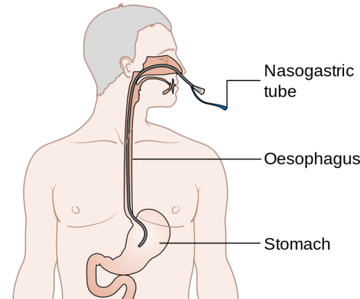 The nasogastric tube goes through the nose and down the throat into the stomach